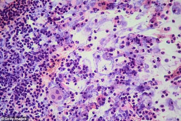 Exclusive: TB Outbreak at Archbishop Riordan High School Sparks Public Health Alert as Third Case Confirmed