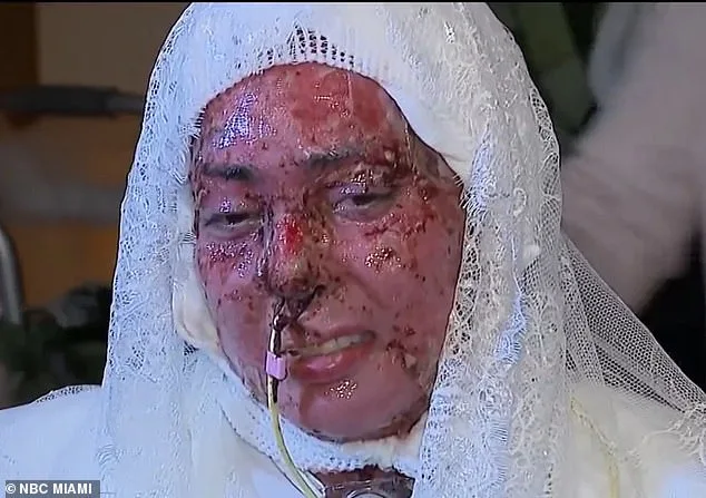 Devastating Grill Explosion: Faulty Gas Line Leaves Arianna Esquiline with Life-Changing Burns