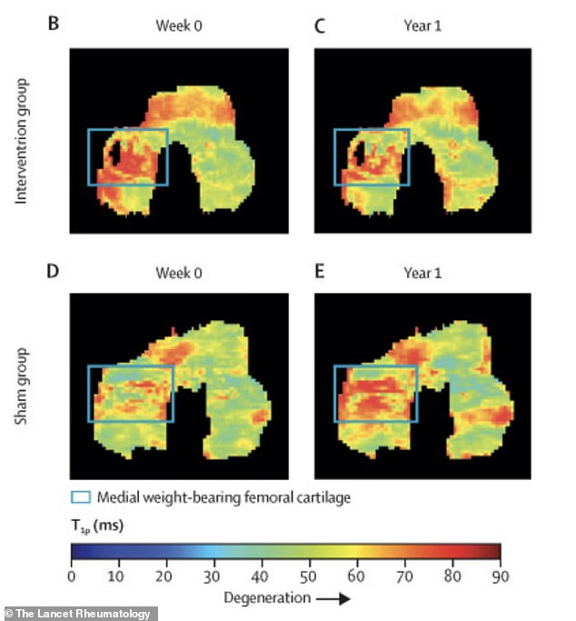 Stanford Study: Tiny Foot Angle Shift Relieves Knee Pain
